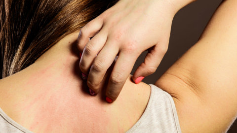 Keto Rash and How To Prevent It
