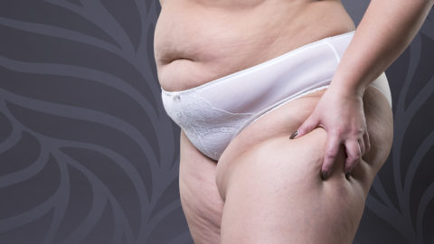 Keto-Mojo Lipedema
