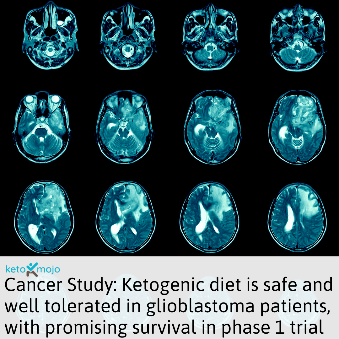 Research Glioblastoma Study