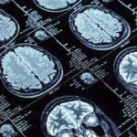 Keto-Mojo-Epilepsy Brain Scan