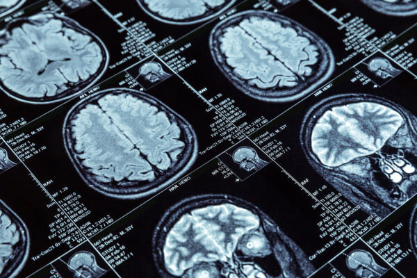 The Ketogenic Diet for Epilepsy